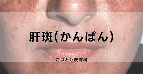 皮膚班|肝斑（かんぱん）の原因・症状と治療法｜品川スキン 